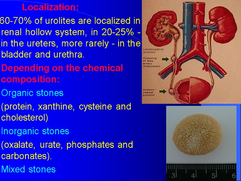 Localization: 60-70% of urolites are localized in renal hollow system, in Localization: 60-70% of urolites are localized in renal hollow system, in